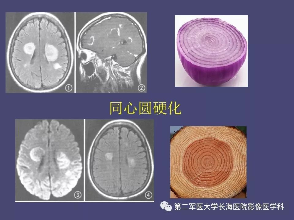 影像PPT - 【PPT】脑内常见环形强化病变的鉴别诊断-44