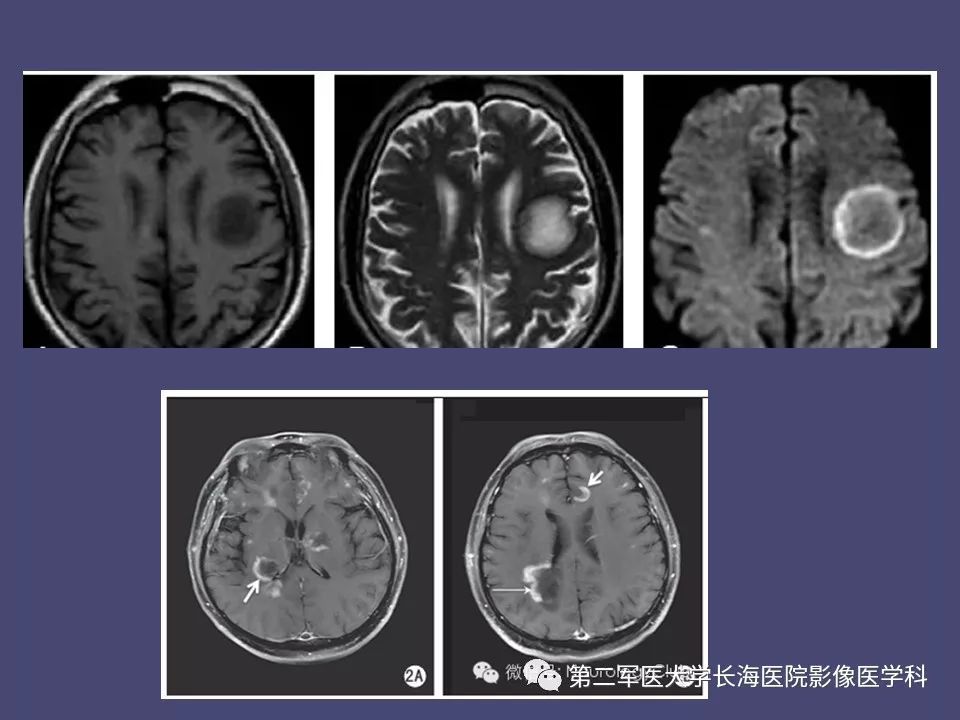 影像PPT - 【PPT】脑内常见环形强化病变的鉴别诊断-47