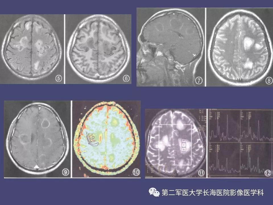 影像PPT - 【PPT】脑内常见环形强化病变的鉴别诊断-45