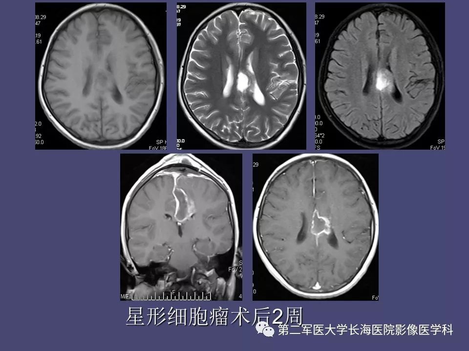 影像PPT - 【PPT】脑内常见环形强化病变的鉴别诊断-52