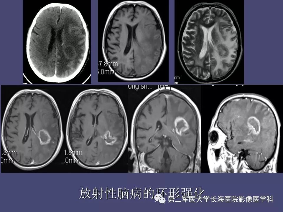 影像PPT - 【PPT】脑内常见环形强化病变的鉴别诊断-55
