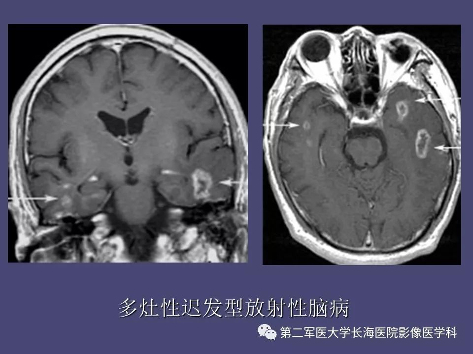 影像PPT - 【PPT】脑内常见环形强化病变的鉴别诊断-56