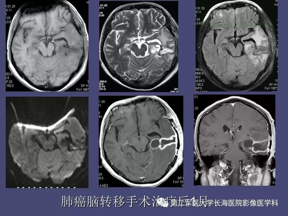 影像PPT - 【PPT】脑内常见环形强化病变的鉴别诊断-51