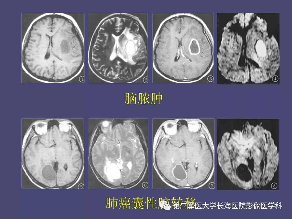 影像PPT - 【PPT】脑内常见环形强化病变的鉴别诊断-60