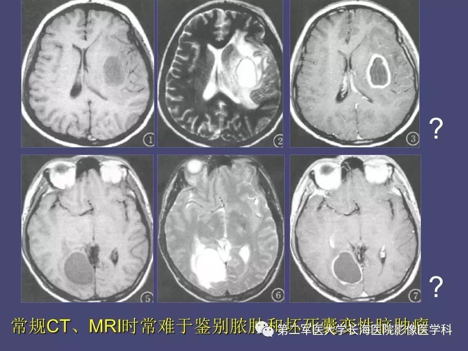 影像PPT - 【PPT】脑内常见环形强化病变的鉴别诊断-59