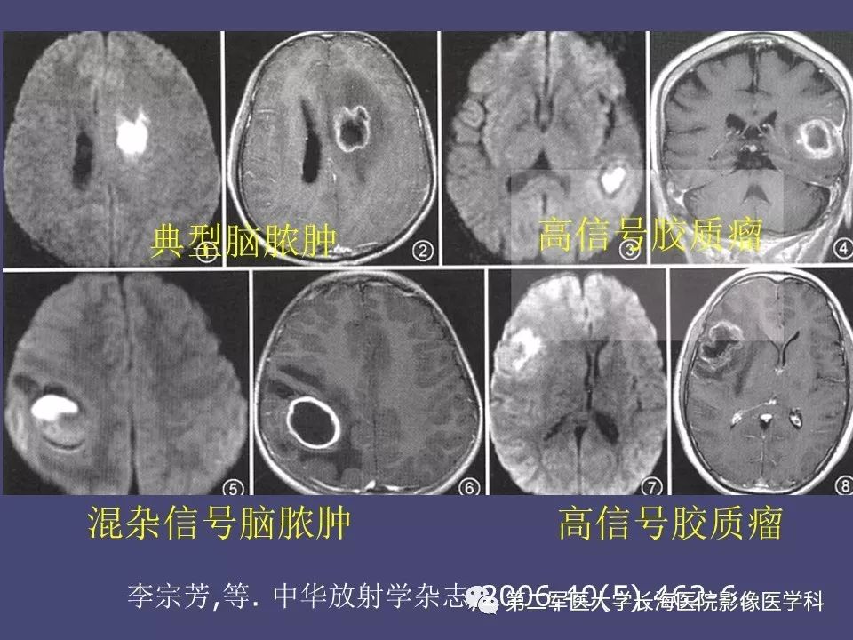 影像PPT - 【PPT】脑内常见环形强化病变的鉴别诊断-62