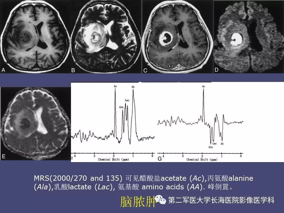 影像PPT - 【PPT】脑内常见环形强化病变的鉴别诊断-67
