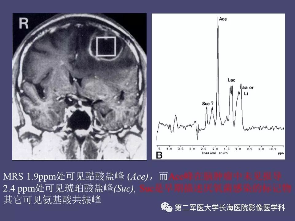 影像PPT - 【PPT】脑内常见环形强化病变的鉴别诊断-66
