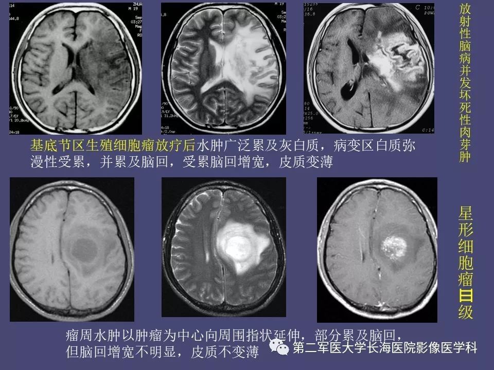 影像PPT - 【PPT】脑内常见环形强化病变的鉴别诊断-72