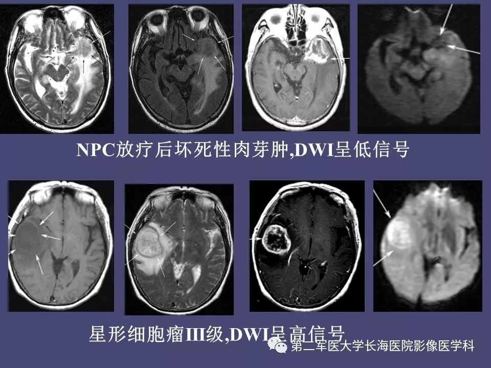 影像PPT - 【PPT】脑内常见环形强化病变的鉴别诊断-73