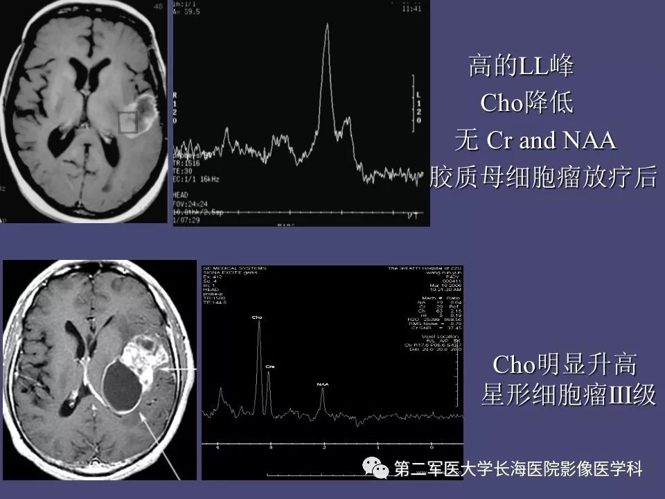 影像PPT - 【PPT】脑内常见环形强化病变的鉴别诊断-76