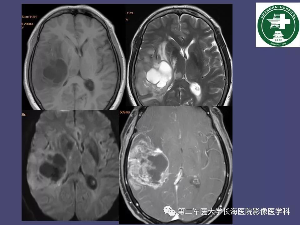 影像PPT - 【PPT】脑内常见环形强化病变的鉴别诊断-78