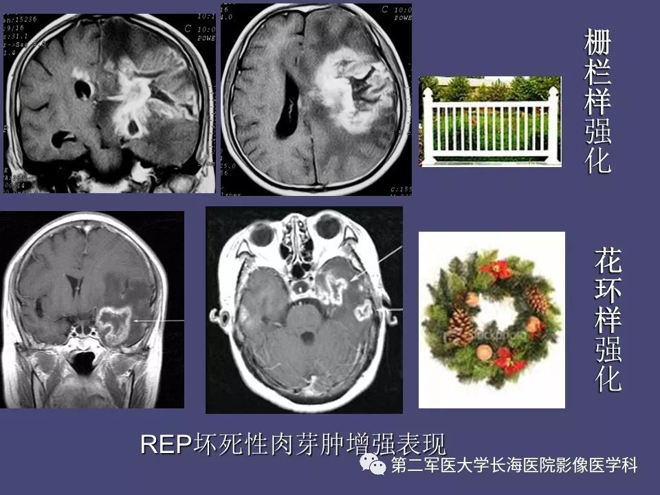 影像PPT - 【PPT】脑内常见环形强化病变的鉴别诊断-74