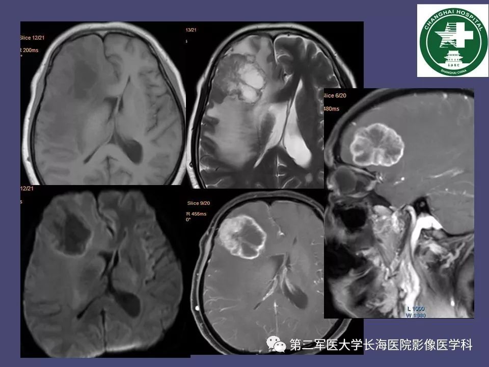 影像PPT - 【PPT】脑内常见环形强化病变的鉴别诊断-80