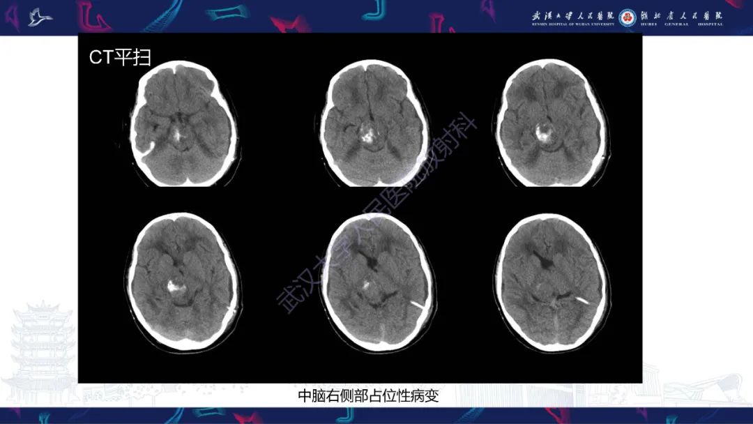 影像PPT - 【PPT】脑节细胞胶质瘤影像诊断-3