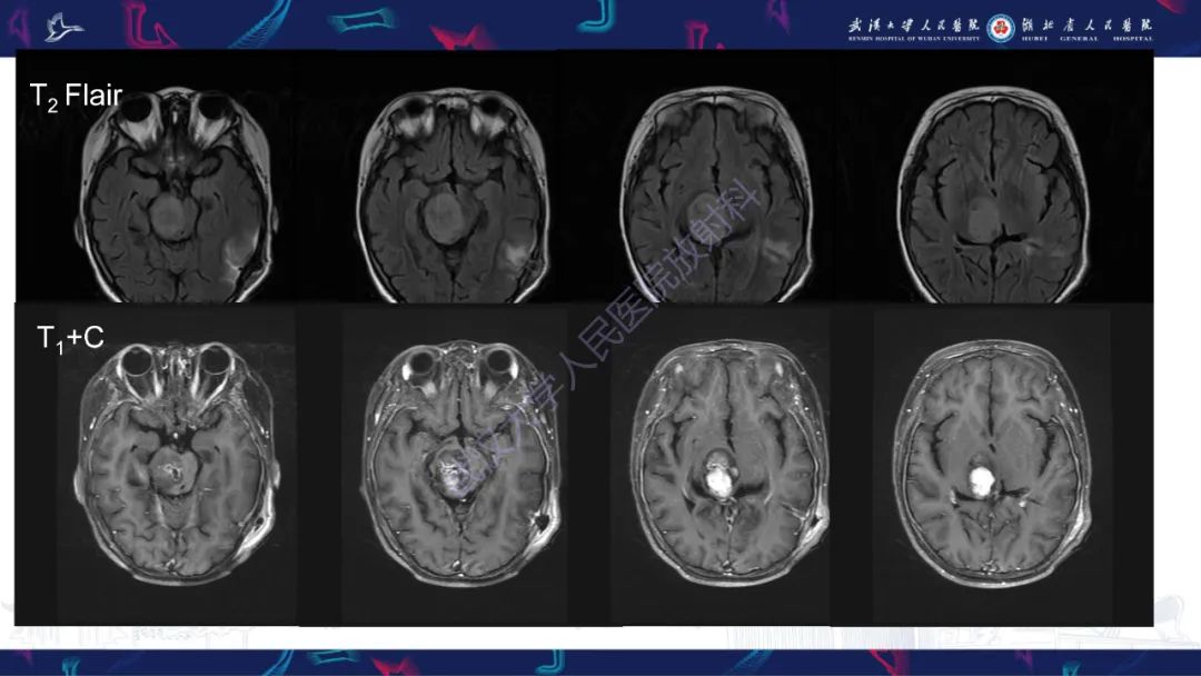 影像PPT - 【PPT】脑节细胞胶质瘤影像诊断-5