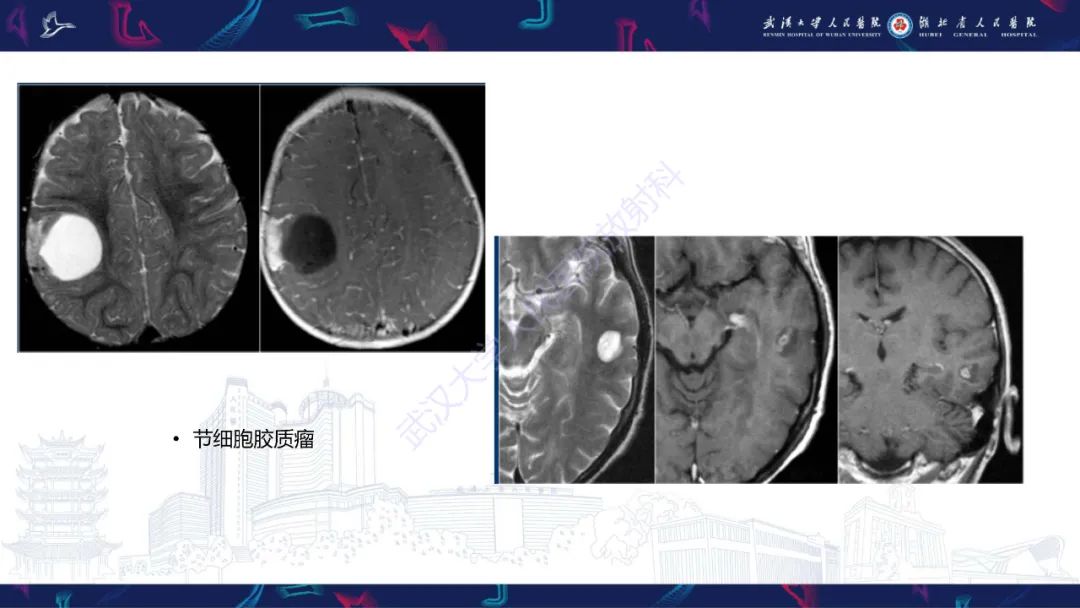 影像PPT - 【PPT】脑节细胞胶质瘤影像诊断-13