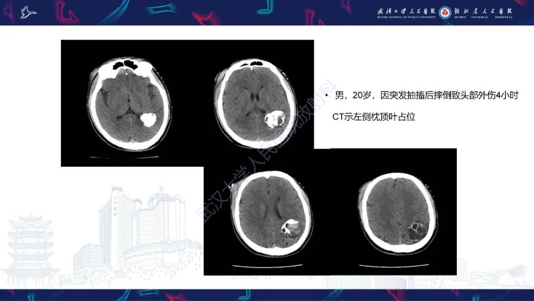 影像PPT - 【PPT】脑节细胞胶质瘤影像诊断-14