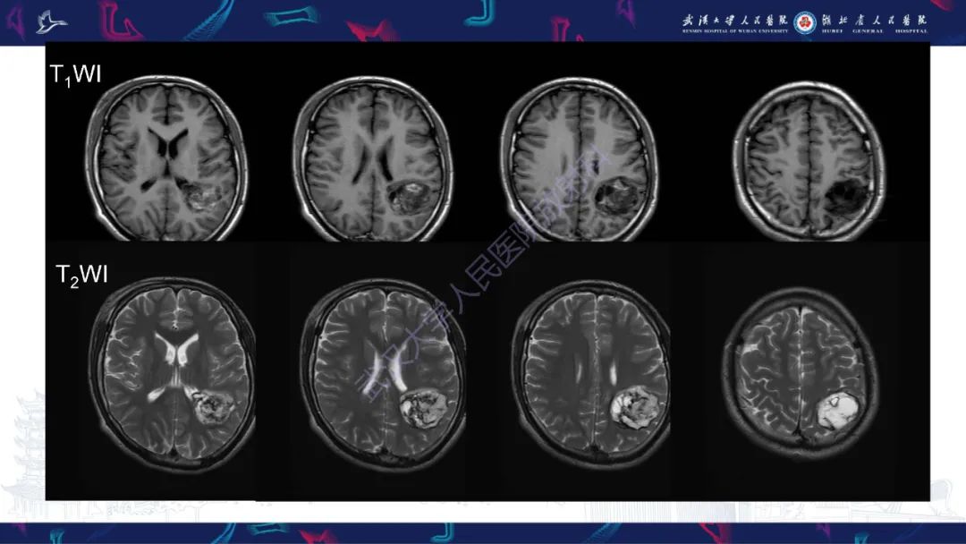 影像PPT - 【PPT】脑节细胞胶质瘤影像诊断-15