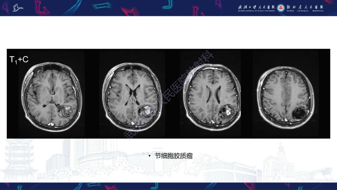影像PPT - 【PPT】脑节细胞胶质瘤影像诊断-16