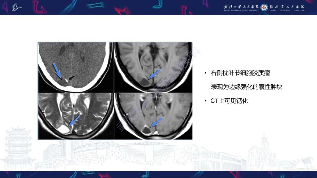 影像PPT - 【PPT】脑节细胞胶质瘤影像诊断-12