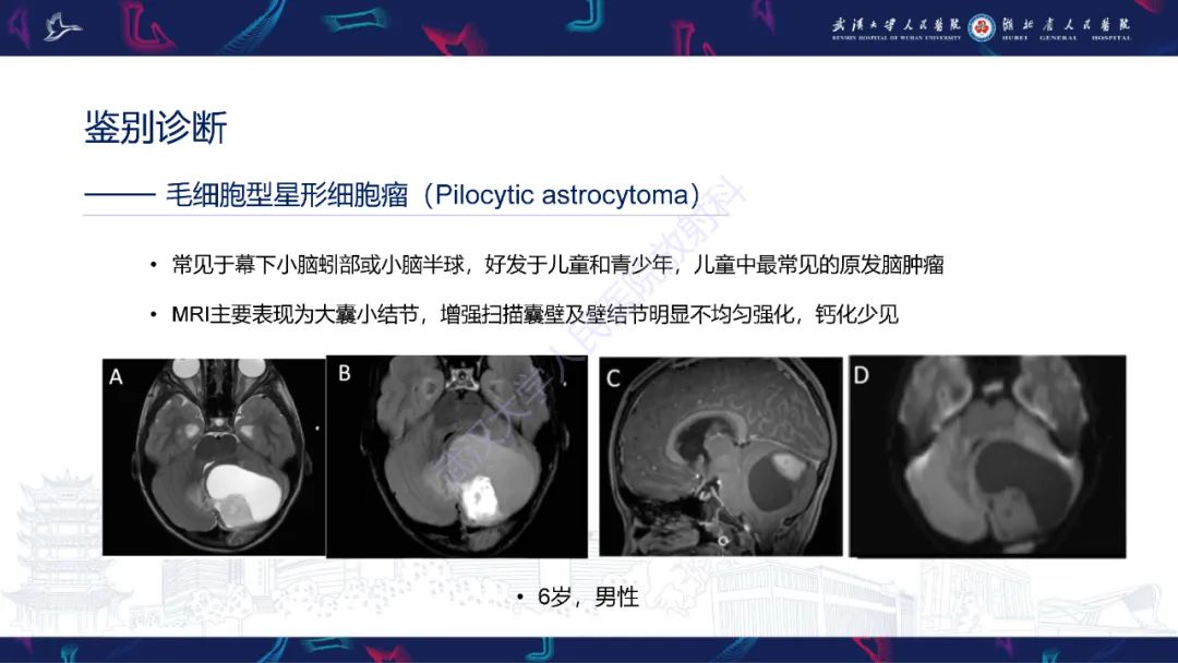 影像PPT - 【PPT】脑节细胞胶质瘤影像诊断-17