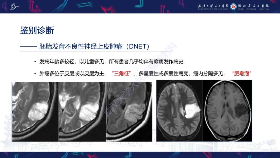影像PPT - 【PPT】脑节细胞胶质瘤影像诊断-18