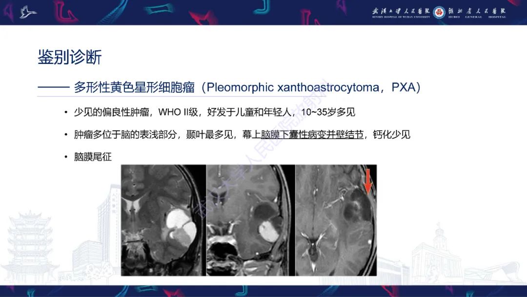 影像PPT - 【PPT】脑节细胞胶质瘤影像诊断-21