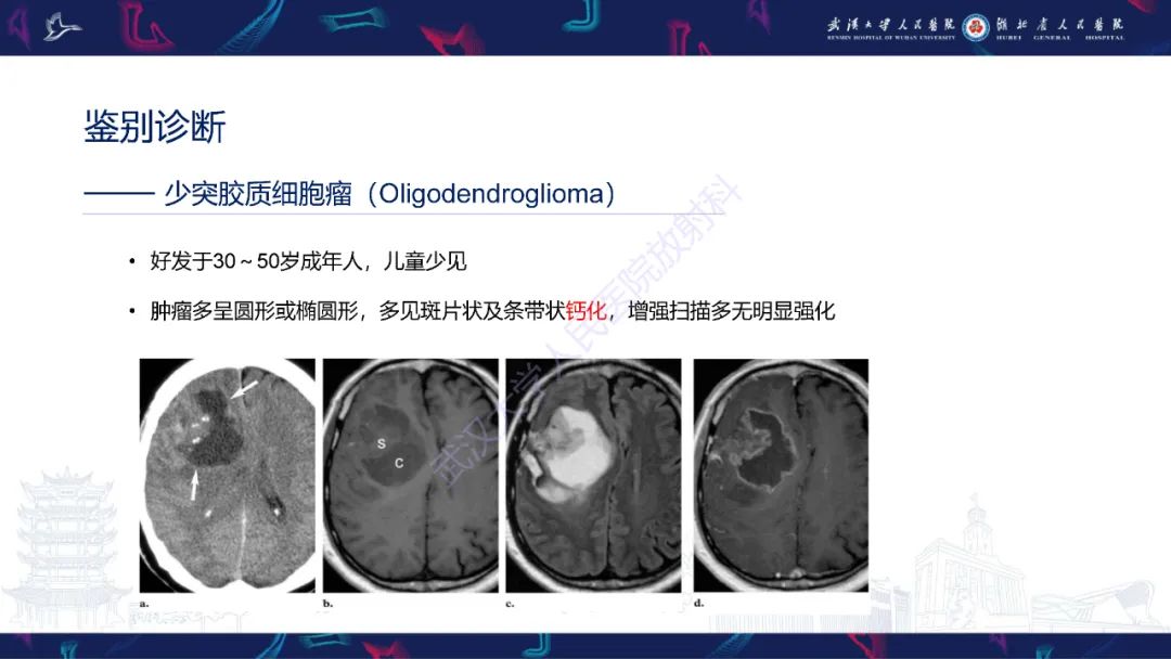 影像PPT - 【PPT】脑节细胞胶质瘤影像诊断-22