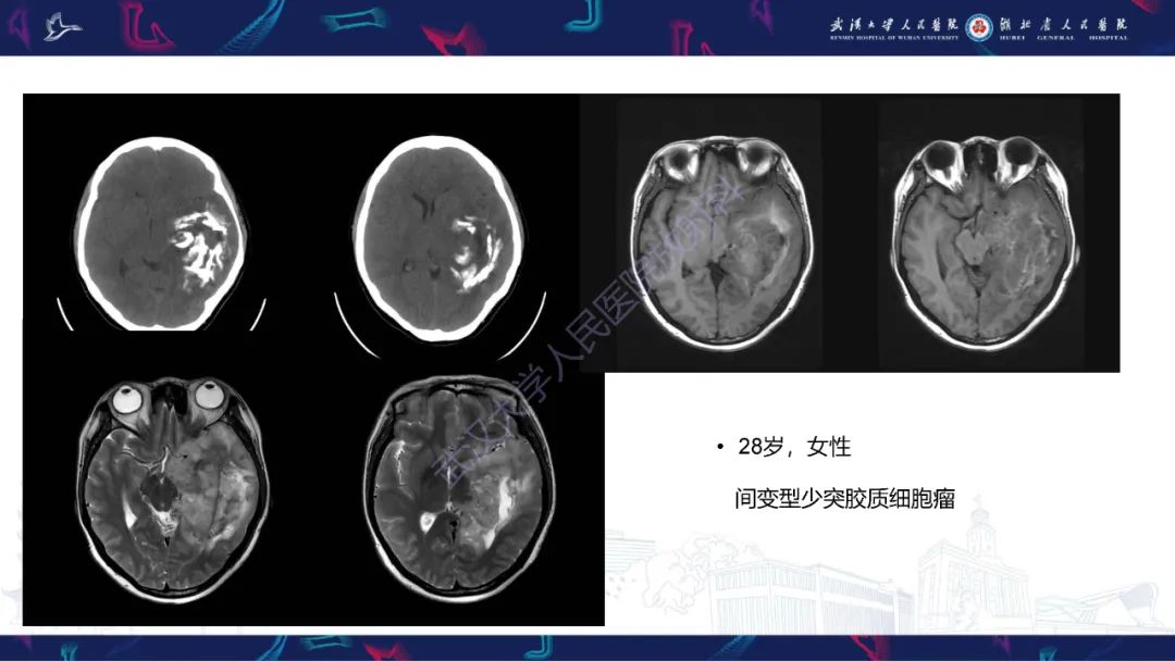影像PPT - 【PPT】脑节细胞胶质瘤影像诊断-23