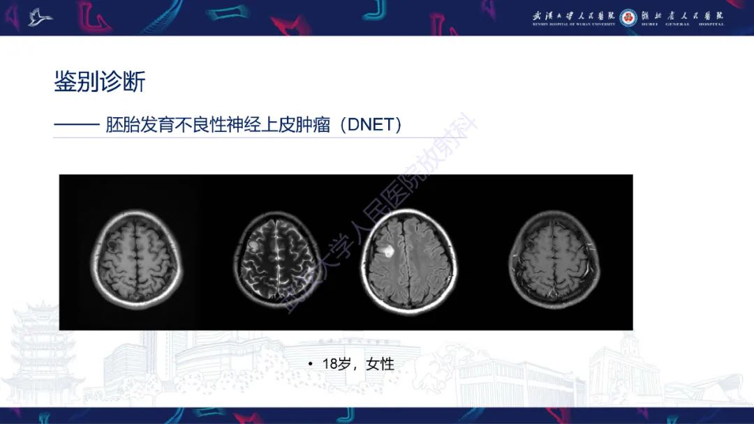 影像PPT - 【PPT】脑节细胞胶质瘤影像诊断-19