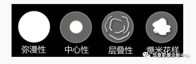 影像PPT - 孤立性肺结节与肺癌鉴别的9大要点-2 影像PPT - 孤立性肺结节与肺癌鉴别的9大要点-2