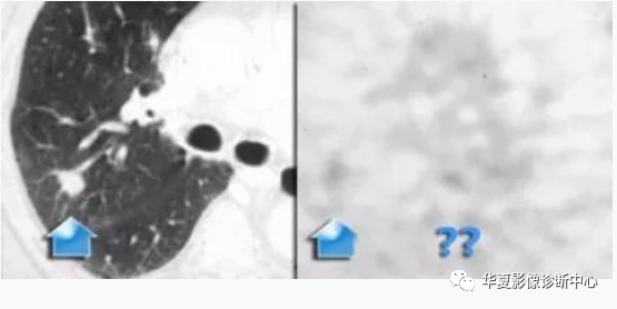影像PPT - 孤立性肺结节与肺癌鉴别的9大要点-11 影像PPT - 孤立性肺结节与肺癌鉴别的9大要点-11