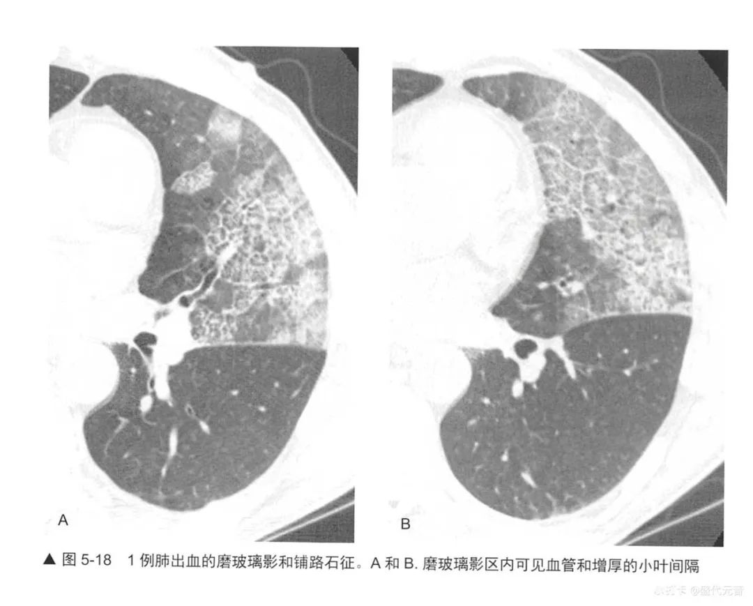 影像PPT - “铺路石征”都见于哪些疾病?-5 影像PPT - “铺路石征”都见于哪些疾病?-5