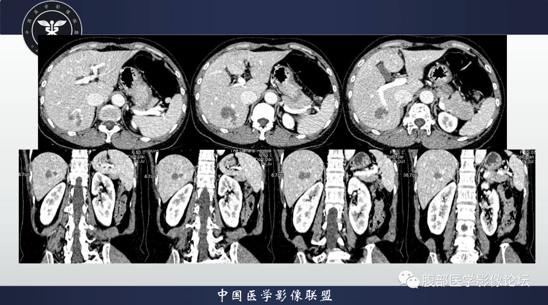 影像PPT - 【病例】肝脏结核1例CT及MR影像-4