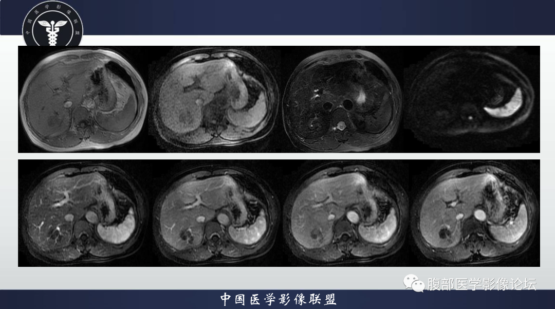 影像PPT - 【病例】肝脏结核1例CT及MR影像-5