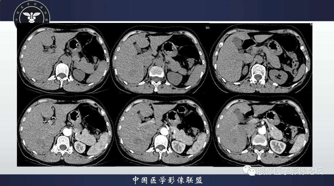 影像PPT - 【病例】肝脏结核1例CT及MR影像-3
