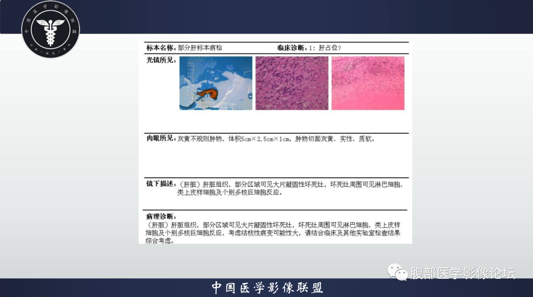 影像PPT - 【病例】肝脏结核1例CT及MR影像-7