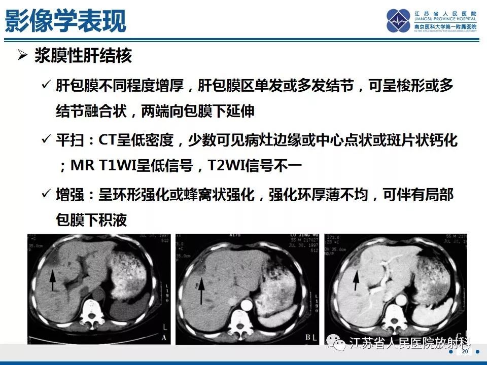 影像PPT - 【病例】肝脏结核1例CT及MR影像-13