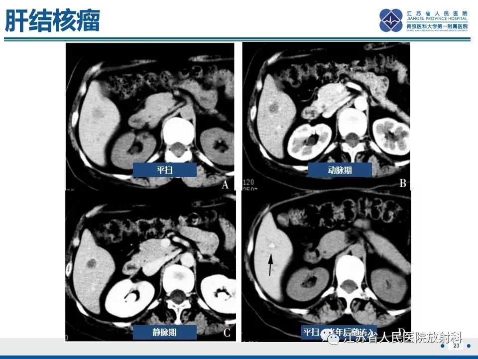 影像PPT - 【病例】肝脏结核1例CT及MR影像-16