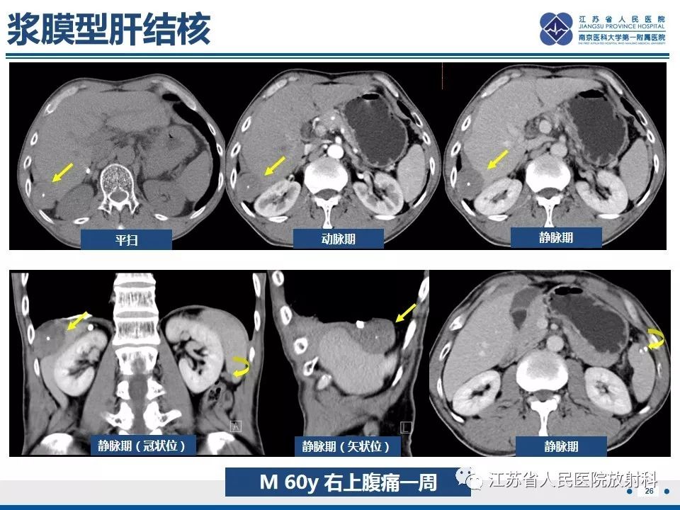 影像PPT - 【病例】肝脏结核1例CT及MR影像-19