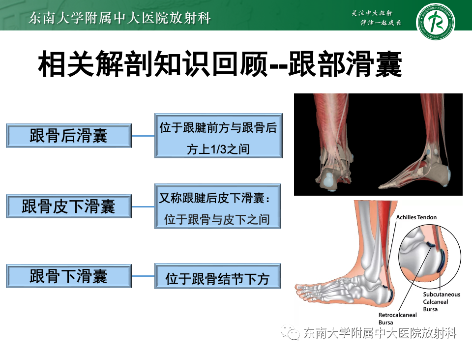 影像PPT - 【PPT】Haglund综合征-8 影像PPT - 【PPT】Haglund综合征-8
