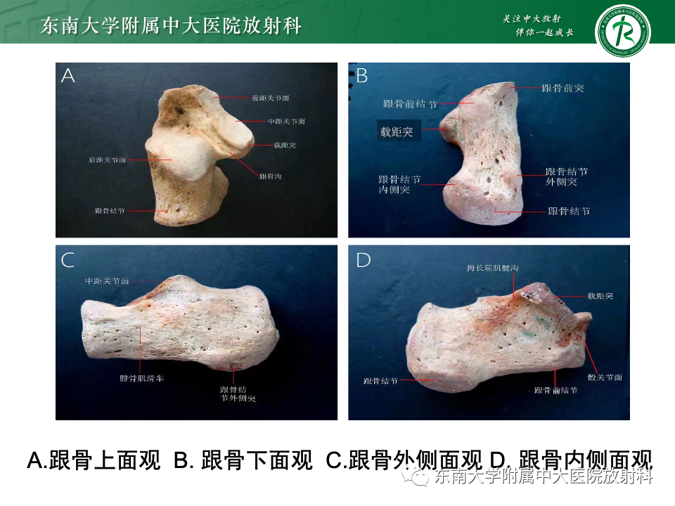 影像PPT - 【PPT】Haglund综合征-10 影像PPT - 【PPT】Haglund综合征-10