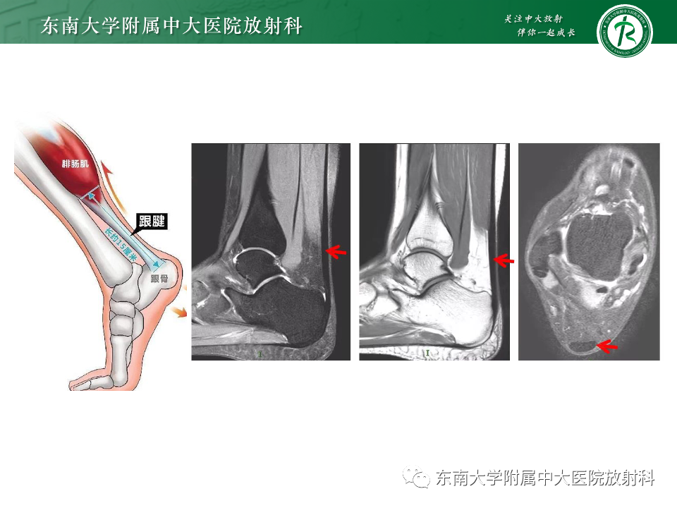 影像PPT - 【PPT】Haglund综合征-7 影像PPT - 【PPT】Haglund综合征-7