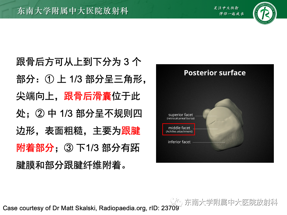 影像PPT - 【PPT】Haglund综合征-14 影像PPT - 【PPT】Haglund综合征-14