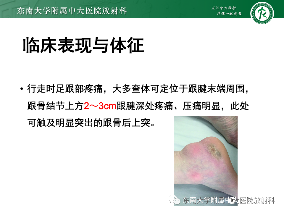 影像PPT - 【PPT】Haglund综合征-15 影像PPT - 【PPT】Haglund综合征-15