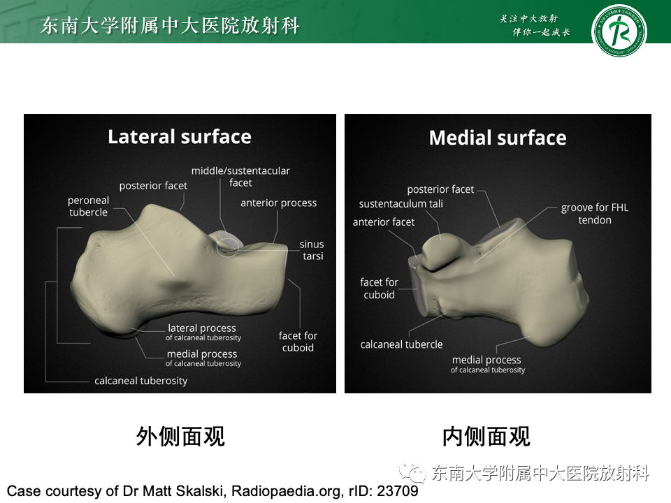 影像PPT - 【PPT】Haglund综合征-12 影像PPT - 【PPT】Haglund综合征-12