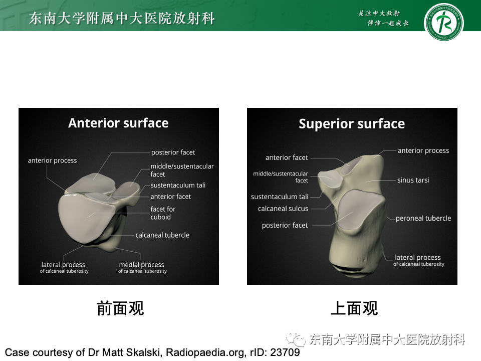 影像PPT - 【PPT】Haglund综合征-13 影像PPT - 【PPT】Haglund综合征-13