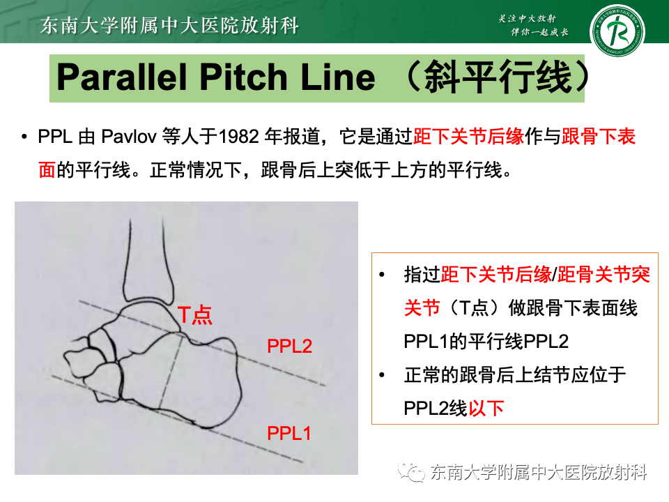 影像PPT - 【PPT】Haglund综合征-18 影像PPT - 【PPT】Haglund综合征-18