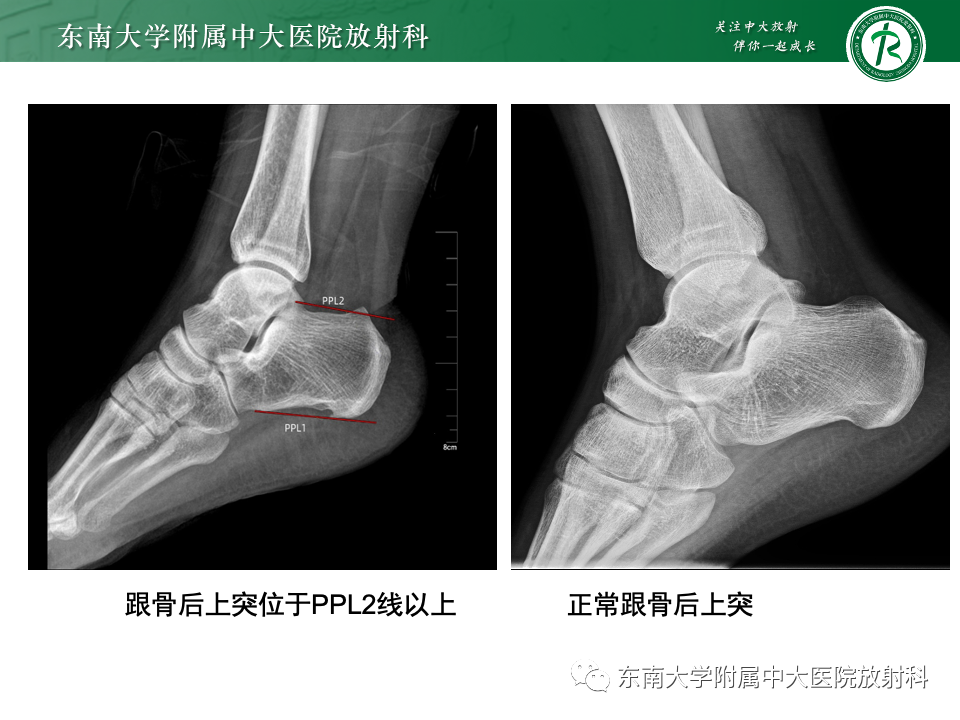 影像PPT - 【PPT】Haglund综合征-19 影像PPT - 【PPT】Haglund综合征-19